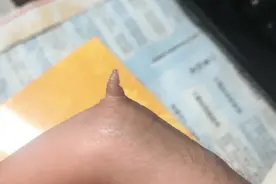 无意发现自己中指多出一块肉，你们看这是得绝症了？我还有救吗？图片