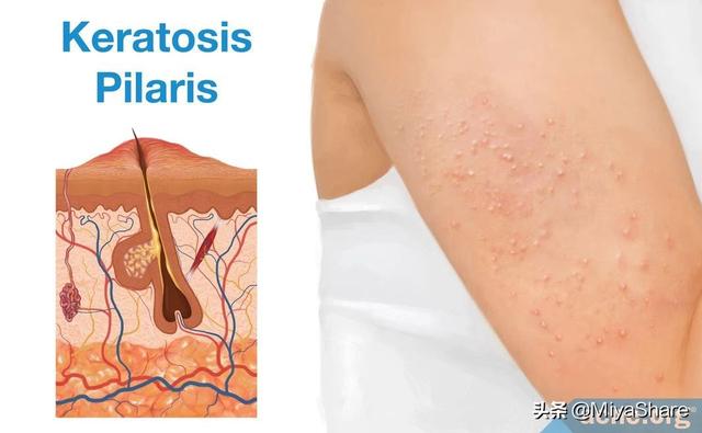 果酸身体乳对鸡皮