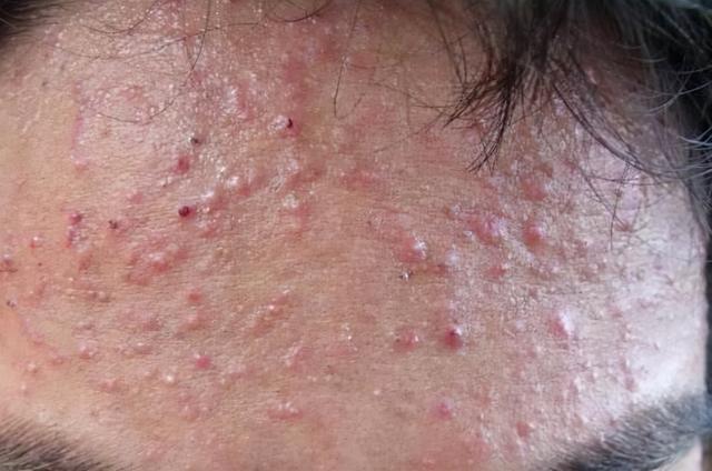 为什么腿上有毛囊角化症