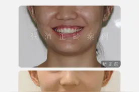 郑州牙齿矫正：深覆颌（深咬合）正畸案例合集图片