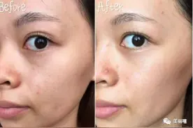 敷完面膜，脸上多余的“精华”真的要洗？还有人不听劝，难怪烂脸图片