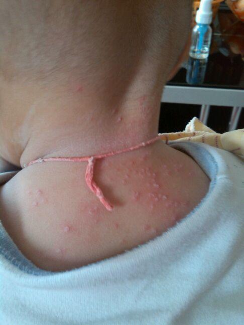 新生儿长痱子可以擦身体乳吗