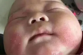 夏季抚触好处多，可“抚触油”湿疹宝宝要慎用，医生建议这样护理图片