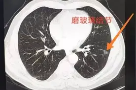 查出6mm肺小结节，3个月缩小至2mm，发现结节后这样做才安全图片