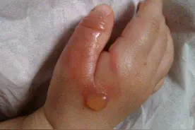 三岁孩子被100度开水烫着，妈妈用1小时4步处理，医生：做得好图片