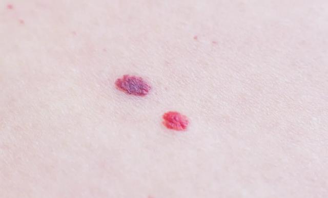 皮肤上出现很多小红点 皮肤上出现很多小红点