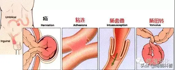 涓撳璇达細鍏充簬鑲犳闃荤殑14涓棶棰? onerror=