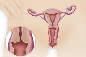 排卵期拉丝度不好，影响女性受孕，多是哪些原因？图片