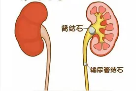 “结石”不再“结实”！钬激光，让肾脏不再受伤图片