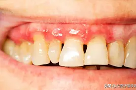为什么会出现牙缝宽的现象？图片