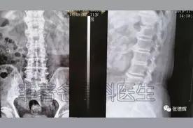 脊柱内镜下的ULBD治疗腰椎中央椎管狭窄（附详细图片）图片