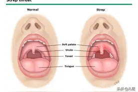 孩子嗓子发炎疼痛，一文教你怎么处理！图片