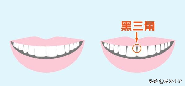 口腔角化龈的概念