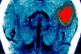 突发脑出血怎么办？医生教您急救方法，有高血压、高血糖的请收藏图片