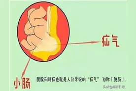 13个月龄女婴儿患“小肠气”图片