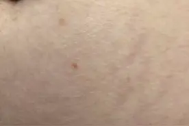 对付妊娠纹，哪些产品好使？医生：买的都是智商税图片