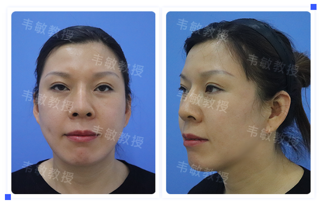 生硬U型脸也能变成柔和小脸，尽显温柔