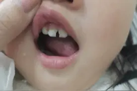 宝宝牙齿龋齿脱矿怎么办图片