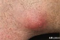 身上出现不明肿物，医生我这里是肿瘤吗？可以切除吗？图片