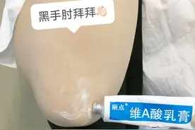 关节变白打卡31天！刷酸真的有用图片