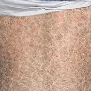 鱼鳞病发病年龄