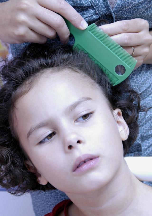 女儿头上长了许多虱子，宝妈用热夹板把头发烫了烫，结果很舒适
