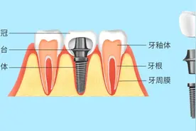 想与种植牙共度余生，这些功课您做了吗？｜老年健康宣传周①图片