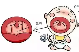 鱼刺卡在我喉咙里二十多天了，医生却让我“刮痧理疗”？图片