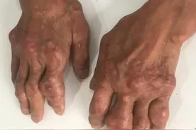 长痛风石有七个特点四个疏忽，去痛风石有三个方法降尿酸是关键图片
