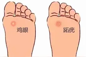 又把跖疣当成鸡眼了？这5招教您如何辨别图片