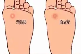 又把跖疣当成鸡眼了？这5招教您如何辨别图片
