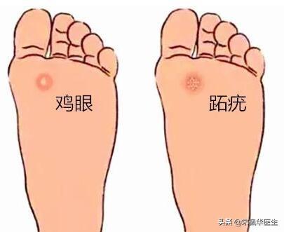 拓疣如何传染给别人,手足疣(跖疣)8分钟大解密!|孙叔公干货 - 冷求网