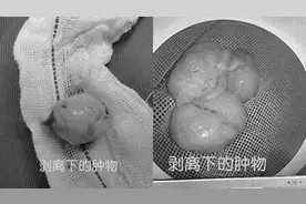南大二附院消化内科肖志华团队成功完成两例内镜黏膜下巨大肿物剥离术图片