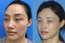 颧弓下颌角截骨术如何改头换面，颧弓下颌角案例实讲图片