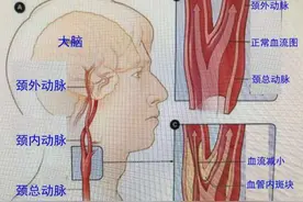 经常脑供血不足？警惕颈动脉堵塞严重！医生为你介绍3个疏通方法图片