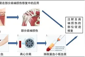 提了一下重物肩膀肌腱竟然撕裂 注射自体血浆大爷胳膊恢复旋转自如图片