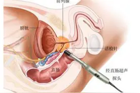 《前列腺穿刺中国专家共识》发布图片