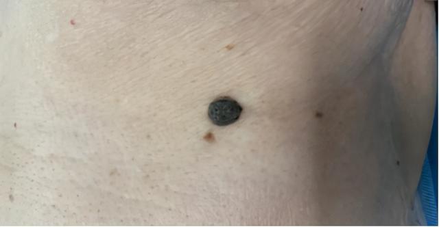 肚皮角化症