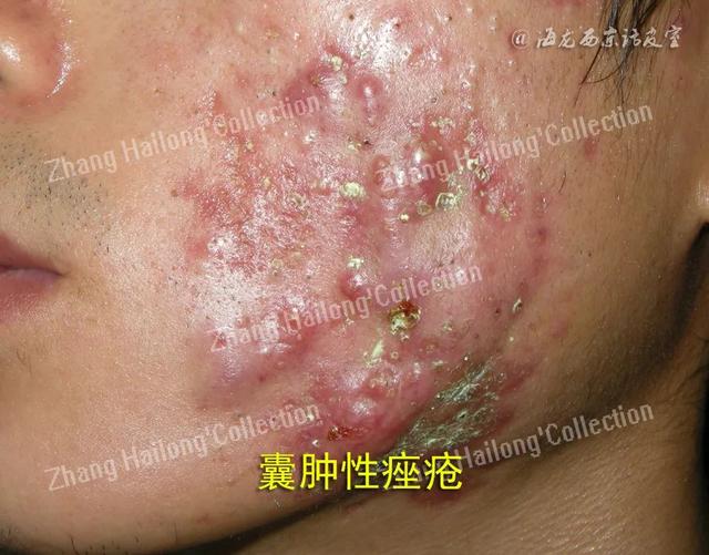艾滋会引起毛囊角化症