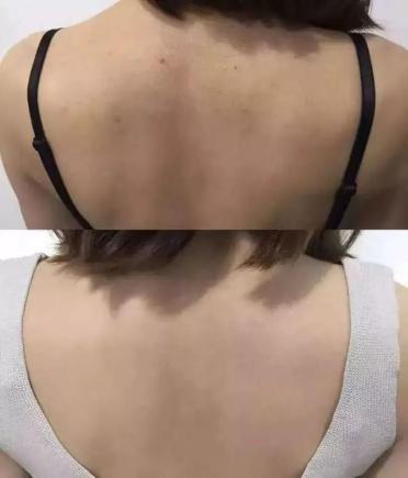 去粉刺毛囊炎痤疮鸡皮身体乳