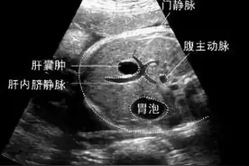 复旦专家告诉你——体检发现“肝囊肿”，该怎么办？图片