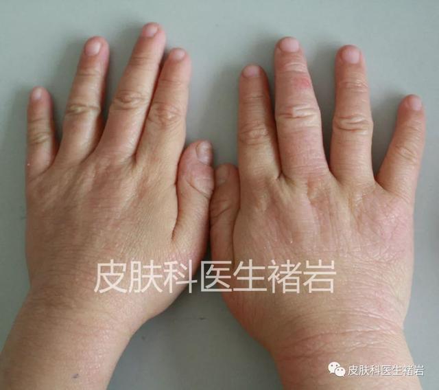 鸡皮疙瘩一块一块红肿