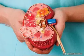 男子多1个肾为何会麻烦不断？多肾增强肾功能吗？如何预防结石？图片