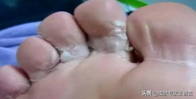 脚底表皮角化过度