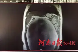 女孩体内长25斤巨大肿瘤腹大如孕妇，在信阳职业技术学院附属医院手术后恢复蛮腰身材图片