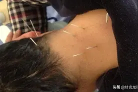 那个被使用了抗精神病药物的患者，被我一次针灸就治愈了图片