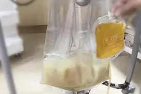 24岁小伙吃完烧烤进ICU，肚子鼓得像篮球，血管里滤出一大袋油图片