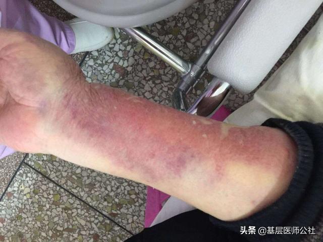 澶嶆柟姘ㄥ熀閰告敞灏勬恫澶栨笚姘磋偪鍏呰涓€澶х墖锛屾€庝箞鍔烇紵