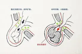 破瓜之年被腹股沟疝"拍了拍"，局麻腹股沟疝修补术完美解决图片