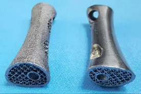 用钽金属3D打印长节段人工椎体重建脊柱缺损 世界首例临床应用在西安成功实施图片
